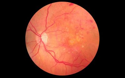 8 Eye Conditions Retinal Imaging Can Diagnose and Monitor